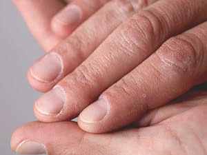 Repair Dry Cracked Hands